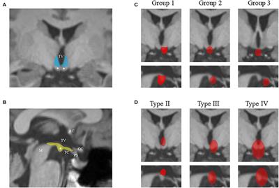 Anatomical features decide the atypical seizure manifestation of parahypothalamic hamartomas